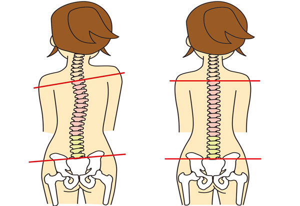 『腰椎ヘルニア』の原因は骨盤のゆがみからきている